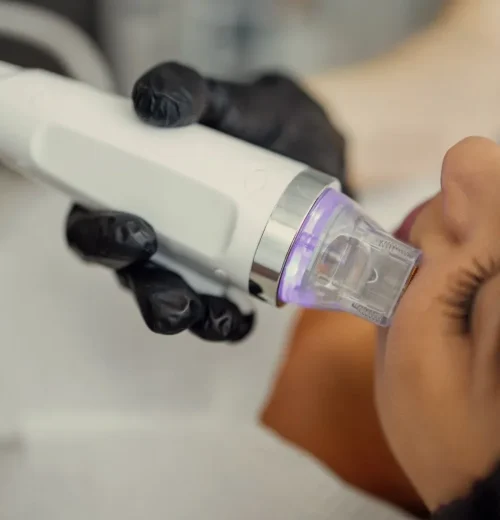 imgi_21_Microneedling+Tallahassee+FL+Aesthetician